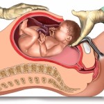 Parto abdominal o por cesárea