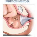 Parto vaginal asistido con ventosa